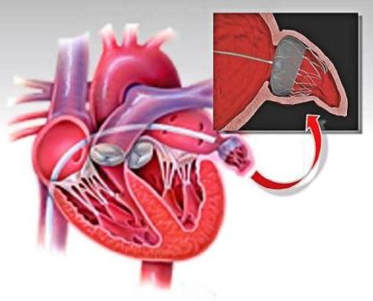 Intra > Procedures and treatments > Interventional cardiology